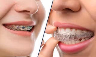 “Không thể để răng xấu suốt kiếp" - niềng răng không phiền phức như bạn tưởng!