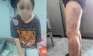Nạn nhân bị hành hung nhiều bộ phận như mặt, chân, lưng