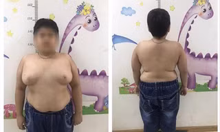 Bé trai 13 tuổi tăng cân mất kiểm soát sau khi lạm dụng thuốc corticoid Ảnh: T.Hà 
