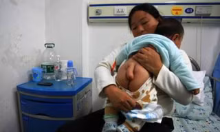 Bé 5 tháng tuổi mọc đuôi dài hơn 12cm