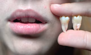 Vì sao răng khôn lại đau và chúng ta có nên nhổ hay không?