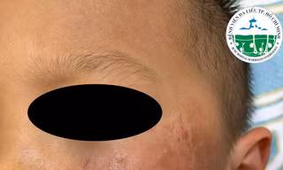 Bé trai 4 tuổi da bỏng rộp vì đồ chơi Halloween