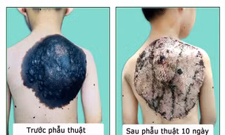 Phẫu thuật thành công “mai rùa” trên lưng bé trai 7 tuổi