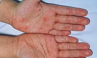 Virus gây tay chân miệng chưa biến đổi độc lực
