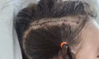 Kỳ diệu phương pháp điều trị viêm não cho bé gái 6 tuổi 