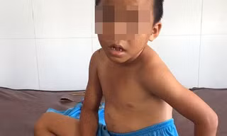 Cháu H. bị cha dượng bạo hành với nhiều vết thương trên người.