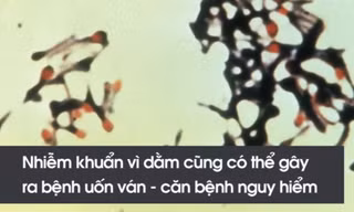 Nguy hiểm nhiễm khuẩn khôn lường từ những miếng dằm nhỏ xíu 