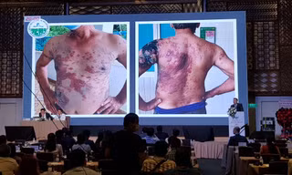 Những dấu hiệu trên da cảnh báo bệnh lý ác tính