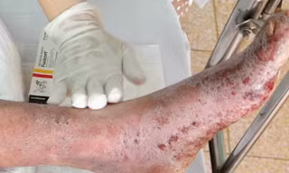 Bệnh nhân bong da toàn thân vì loại vi khuẩn nguy hiểm kháng thuốc