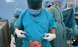 Đắp lá điều trị, người phụ nữ mang khối ung thư đến 30 cm ở 'vùng kín' 