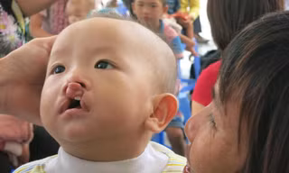 Mỗi năm, hàng nghìn trẻ chào đời bị dị tật hàm mặt