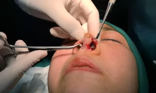 Nâng mũi trong khách sạn, 2 phụ nữ bị tai biến và trộm cắp tài sản