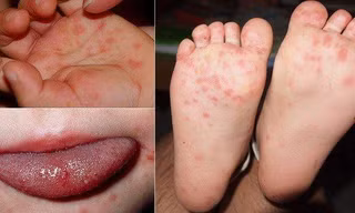 Cuối năm trẻ mắc bệnh tay chân miệng tăng