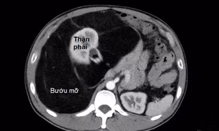 Người đàn ông 'chửa' với khối bướu mỡ khổng lồ hiếm gặp