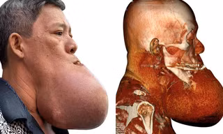 Cứu bệnh nhân bị 'nổ tung' khối u khổng lồ