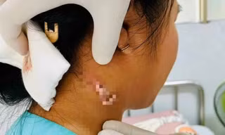 TPHCM: Phát hiện ca bệnh nhiễm 'vi khuẩn ăn thịt người' 