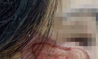 Quý bà nát hết mặt vì làm đẹp bằng dung dịch a xít