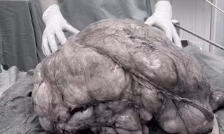 Người đàn ông ở TPHCM mang 'bụng bầu' nặng gần 18kg