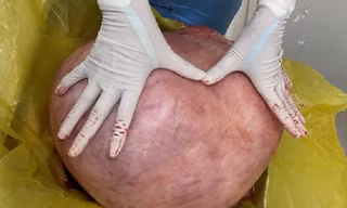 Nữ bệnh nhân nhiều năm mang u quái khổng lồ 11 kg vì nghĩ... mình mập