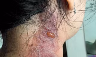 Cảnh báo hiểm họa kiến ba khoang 'tấn công' người trong mùa mưa