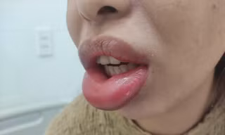 Liên tiếp 2 bệnh nhân bị tai biến thẩm mỹ sau tiêm filler