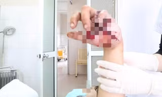 Thiếu niên bị nát bàn tay, lộ xương vì pháo tự chế