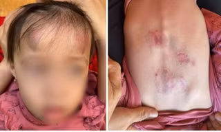 Những vết bầm tím của bé gái bị đánh ở lớp mầm non đăng tải trên mạng xã hội. 