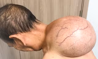 Phẫu thuật cắt bỏ thành công khối u 'khổng lồ' trên lưng cụ bà 95 tuổi