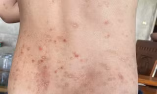 Hàng trăm người ở Hà Tĩnh bị côn trùng đốt gây sẩn ngứa