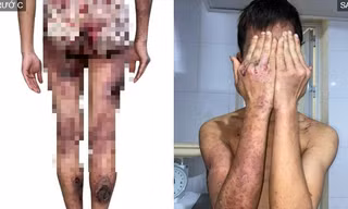 Nam thanh niên'nát hết người' vì chế biến kiến ba khoang thành dung dịch chữa ngứa