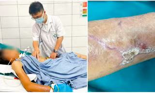 Cứng hàm, suy hô hấp vì vết xước nhỏ, cảnh báo 'đặc biệt' từ hai ca uốn ván nặng