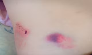Thương tích trên người ông Th. Ảnh B.N