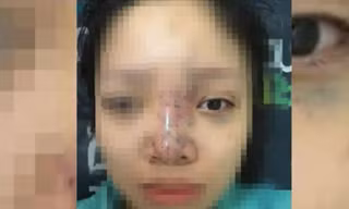 Bản tin 14H: Chủ spa tiêm filler cho sinh viên suýt mù mắt bỏ trốn