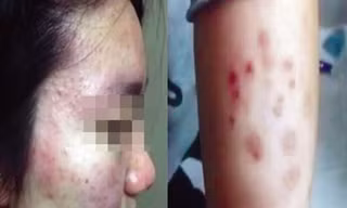 Một học sinh của Trường Ngoại ngữ Thường Châu bị nổi nốt đỏ lạ trên da.