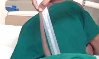 Chiếc đuôi dài tới 18 cm của thiếu niên ở Ấn Độ.