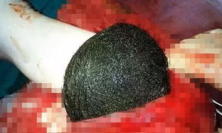 Búi tóc được đưa ra khỏi bụng bệnh nhân.