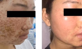 Bệnh nhân trước và sau 5 ngày điều trị 
