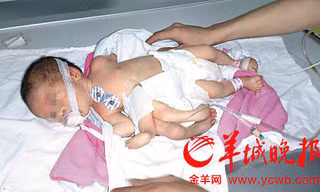 Em bé tám chân tay ở Trung Quốc