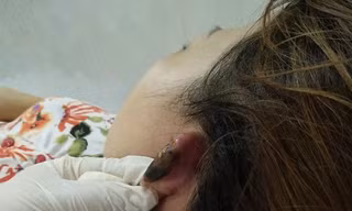 Nguy cơ bỏng da đầu, hoại tử vành tai của do làm đẹp.