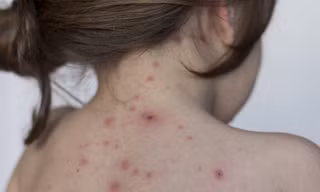 Thủy đậu vào mùa, hàng trăm người nhập viện