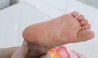 Lại thêm trẻ tử vong vì bệnh tay chân miệng