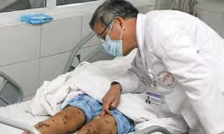 Nhanh chóng găn chặn nguy cơ lây lan dịch não mô cầu nguy hiểm