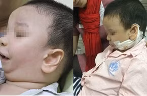 Kéo dãn xương hàm điều trị dị tật bẩm sinh
