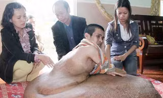 Giải cứu người có khối u 80 kg
