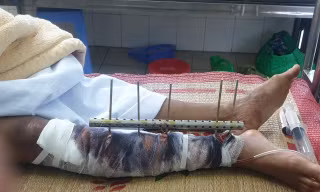 Ngư dân Đỗ Đức Long bị tấn công gãy dập chân và đa chấn thương vùng đầu.