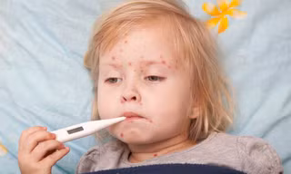 Cách phòng và chữa bệnh sởi cho trẻ