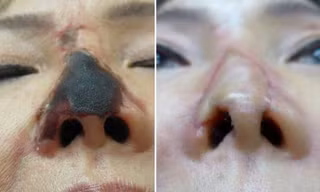  Bị hoại tử mũi sau khi tiêm chất làm đầy