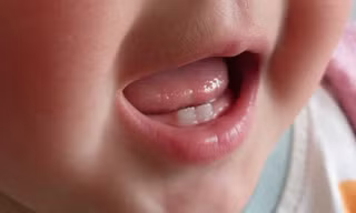 Các bệnh răng miệng phổ biến ở trẻ