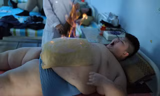 Cậu bé 11 tuổi nặng 145kg đốt mỡ thừa bằng giác hơi
