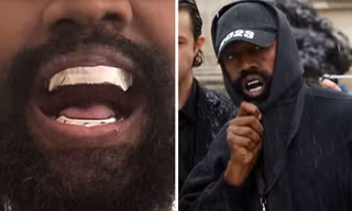 Kanye West gây sốc khi nhổ hết răng thật
